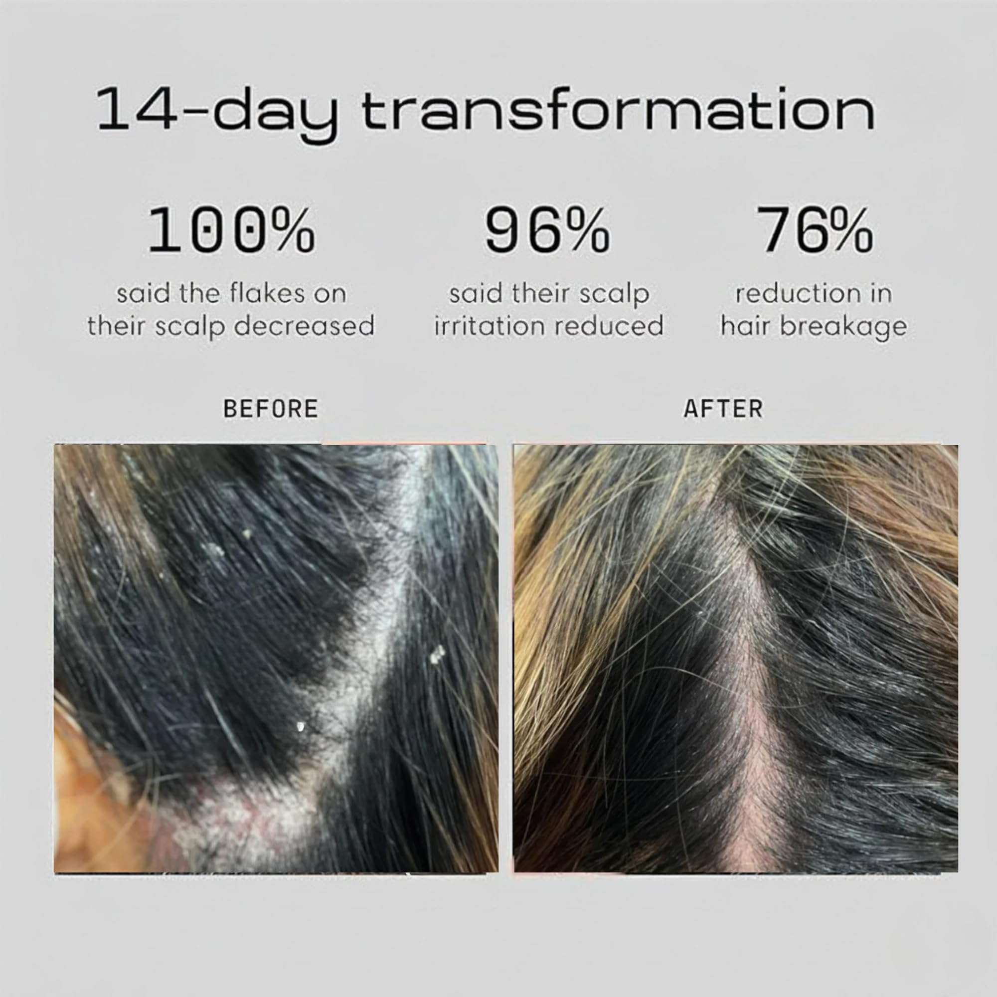 Amazon.com : DANDRX Anti-Dandruff Shampoo with 2% Pyrithione Zinc